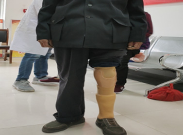 鎂合金雙叉動(dòng)踝小腿假肢