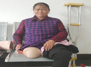 合金四連桿氣壓關(guān)節(jié)大腿假肢